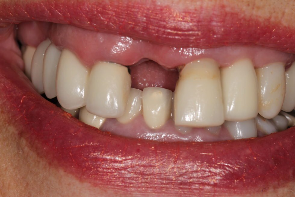 Replace A Single Tooth All Smiles Dental Implants Centre