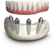 A 3D digital illustration of an all-on-4 dental implant system, showing four titanium implants embedded in the lower jawbone supporting a full-arch prosthetic bridge