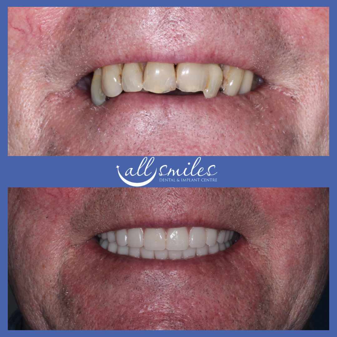 Before and after dental restoration at All Smiles Dental & Implant Centre, Bromley. Top: Discolored, uneven teeth. Bottom: Bright, straight, complete smile