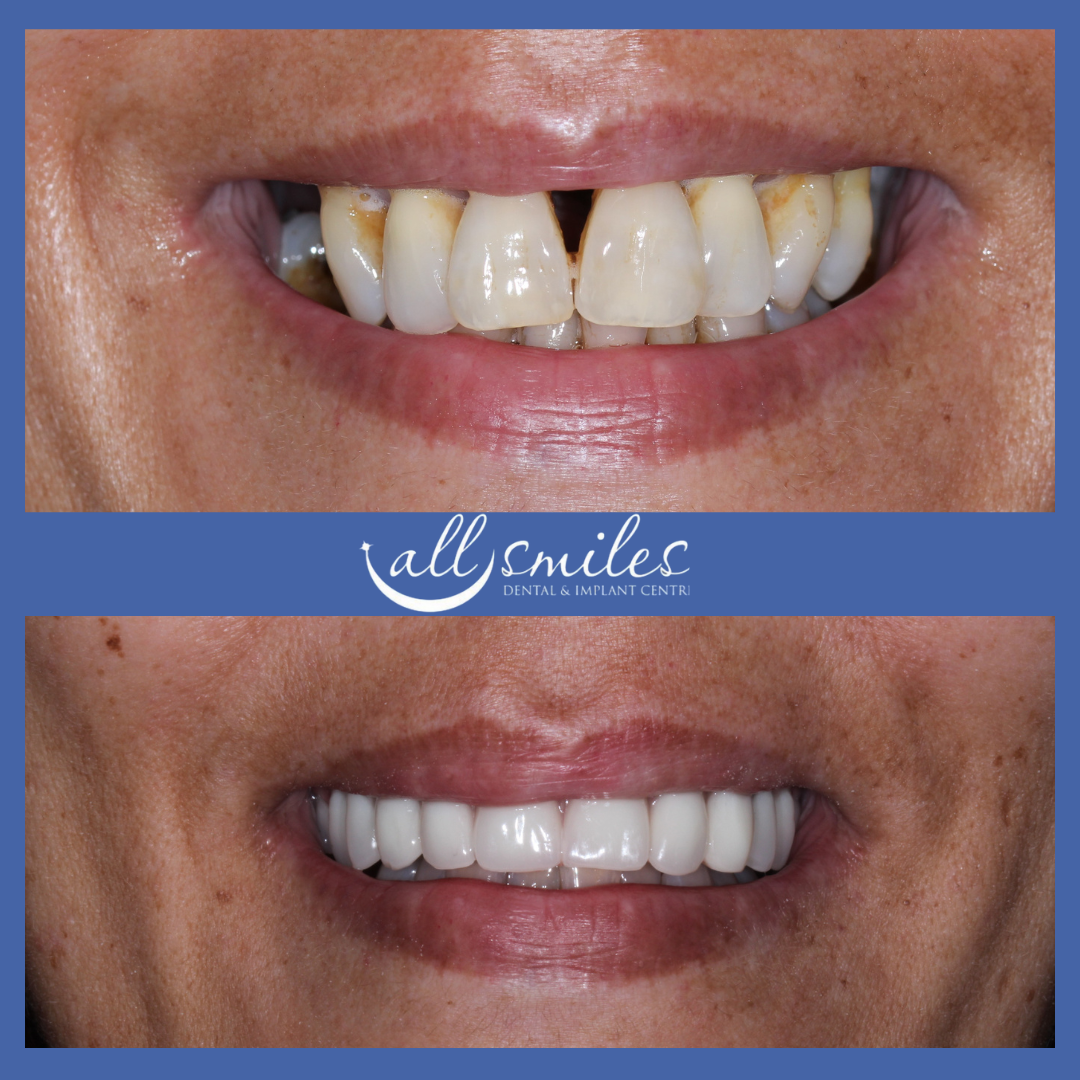 Before and after close-up of a smile. Top: Damaged, discolored teeth with a noticeable gap. Bottom: Bright, straight, complete set of teeth.
