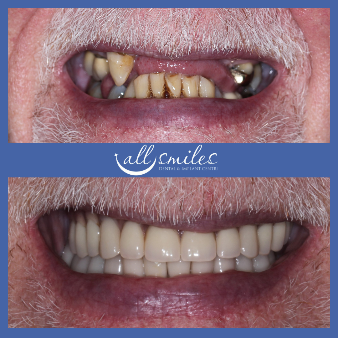 Before and after dental implants, All Smiles Dental & Implant Centre, Bromley. Top: Missing teeth, damaged gums. Bottom: Full set of bright, restored teeth