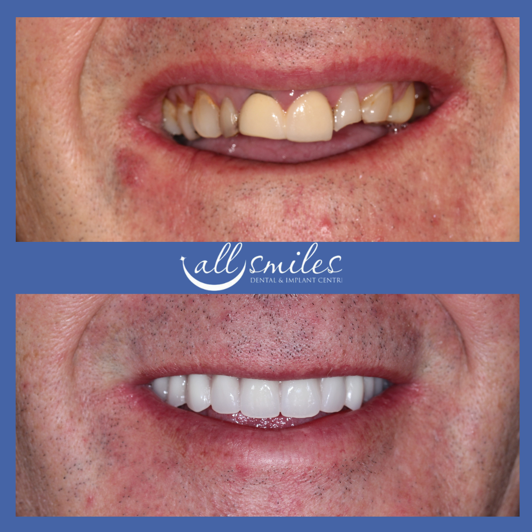 Before and after dental veneers, All Smiles Dental & Implant Centre, Bromley. Top: Discolored, uneven teeth. Bottom: Bright, straight, natural-looking teeth.