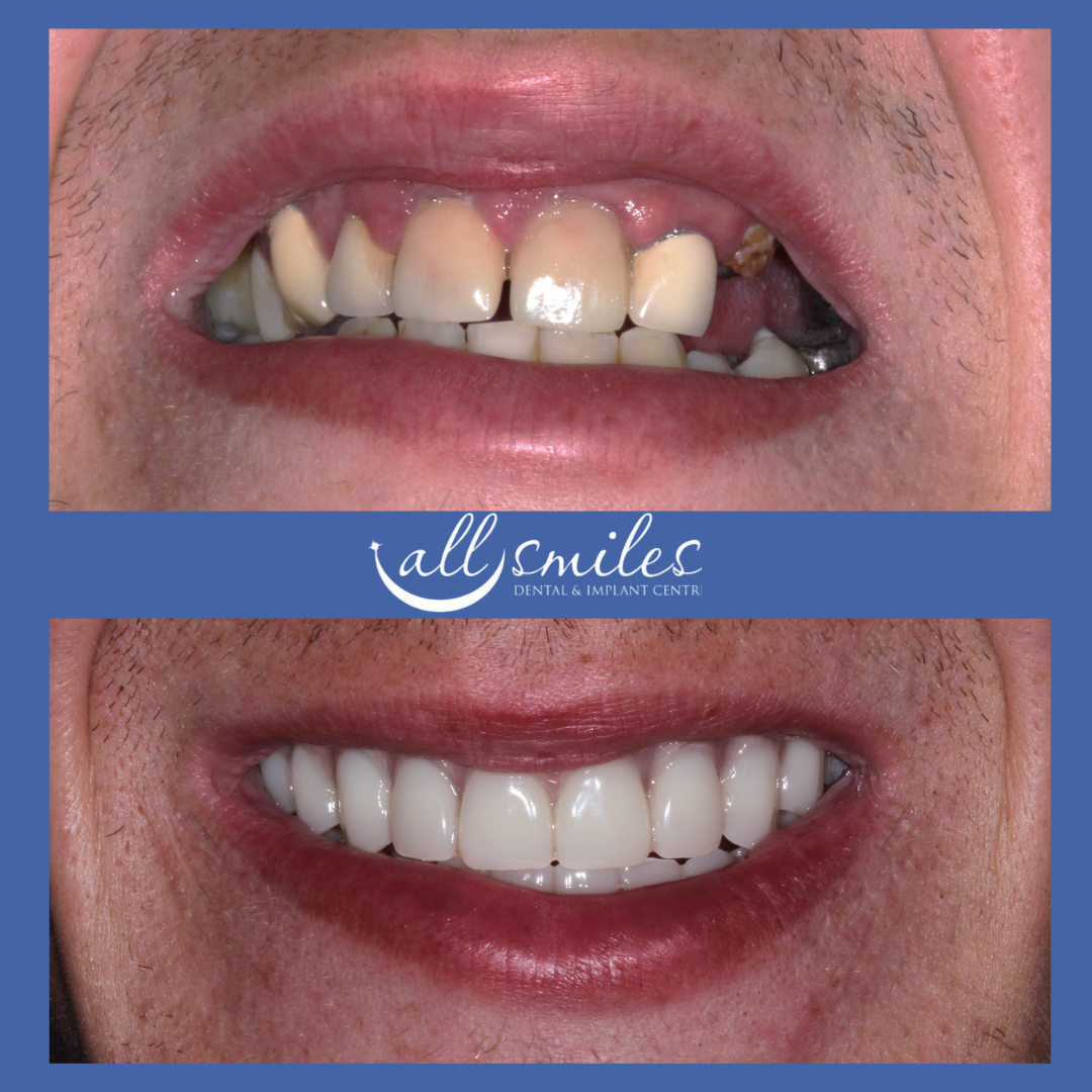 Before and after dental restoration, All Smiles Dental & Implant Centre, Bromley, England, UK. Top: Damaged, discolored, and missing teeth. Bottom: Bright, straight, and fully restored smile.