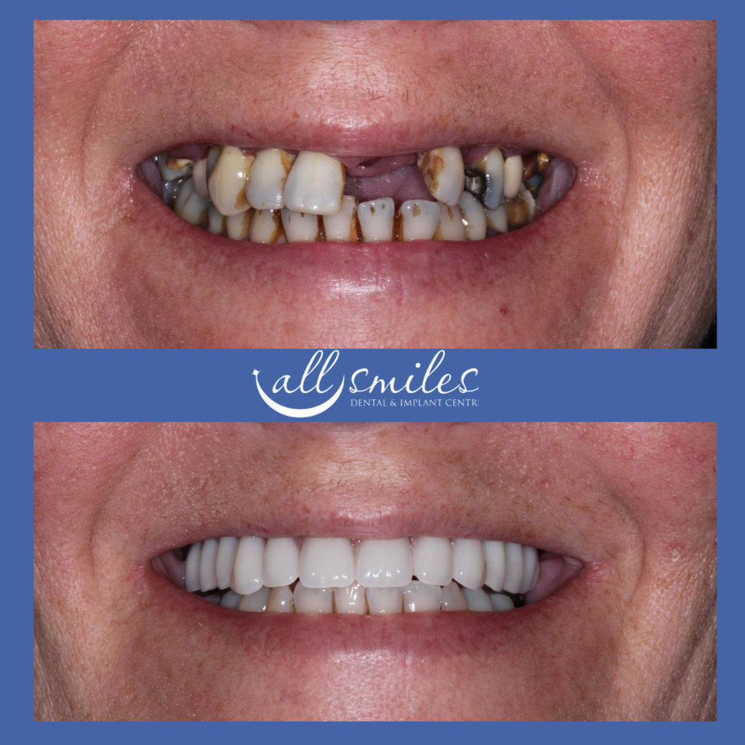 Before and after dental restoration. Top: Damaged, discolored teeth with gaps. Bottom: Bright, straight, complete set of teeth.