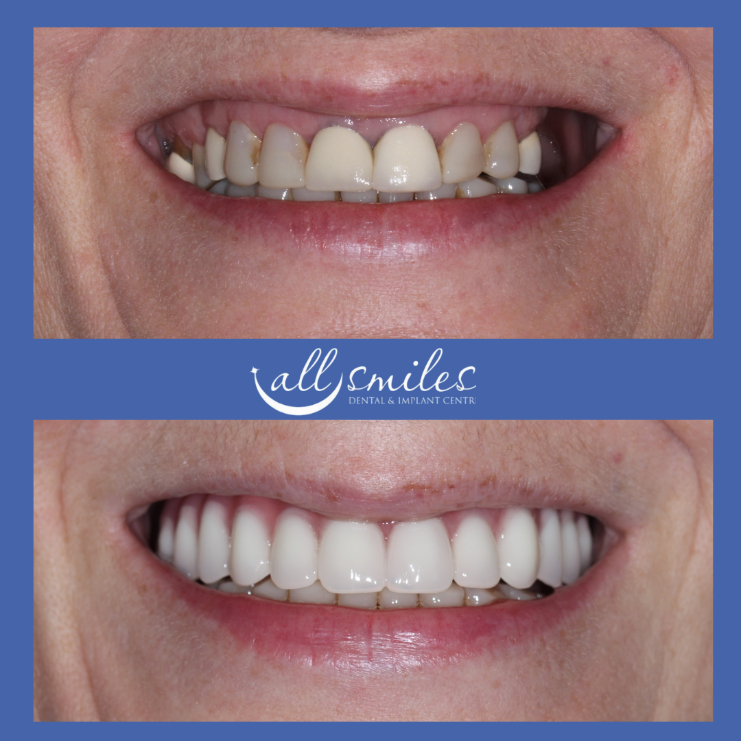 Before and after same-day dental implants, All Smiles Dental & Implant Centre, Bromley, England, UK. Top: Missing teeth, damaged gums. Bottom: Full set of bright, restored teeth, same-day procedure.