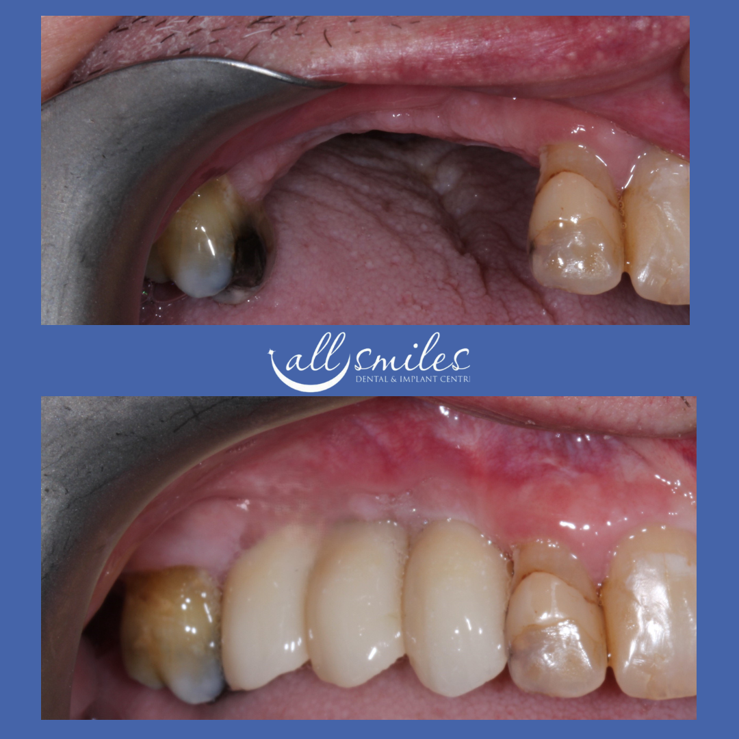 Before and after dental implant and bridge, All Smiles Dental & Implant Centre, Bromley, England, UK. Top: Missing teeth, exposed gums. Bottom: Restored teeth with implant and bridge